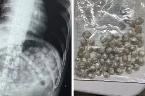 Homem engoliu 61 buchas de maconha — Foto: Montagem/g1