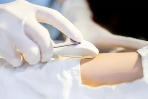 Curvelo passa a oferecer Implanon pelo SUS para ampliar cuidado com a saúde da mulher