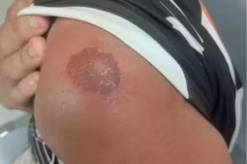 Uma das lesões apresentadas pela vítima — Foto: Polícia Militar